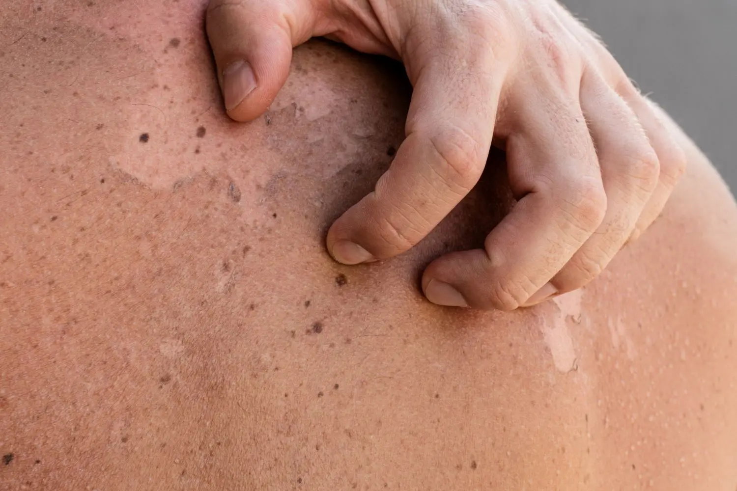 heroin effects on skin